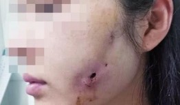 郑州整形失败爆料案件最新,揭秘美容行业潜规则与维权困境