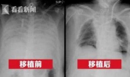 港媒最新爆料新冠肺病人,新冠肺病患者真实生活现状及挑战”